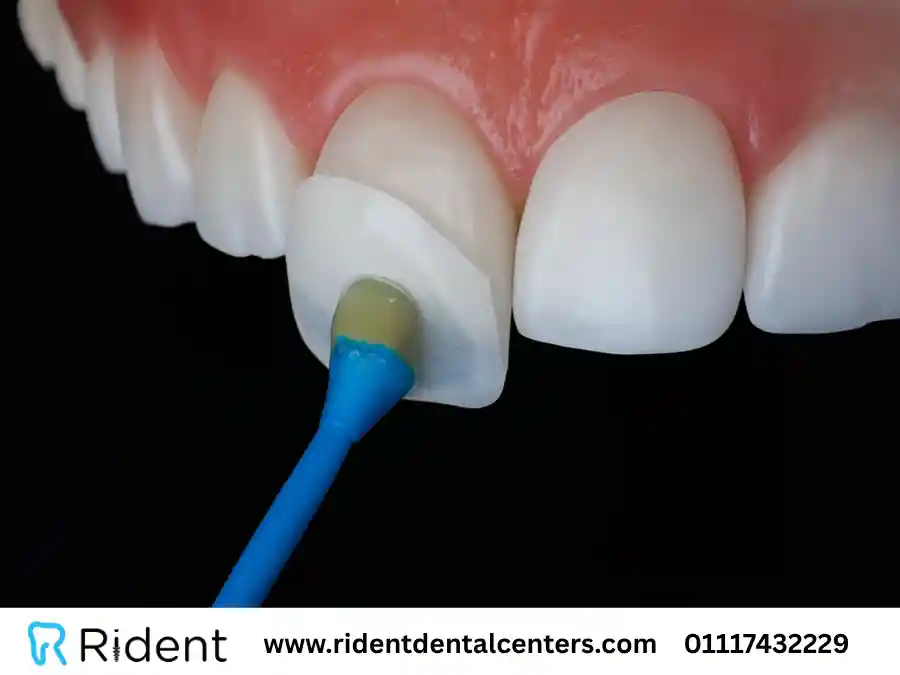 ما هي عدسات الأسنان